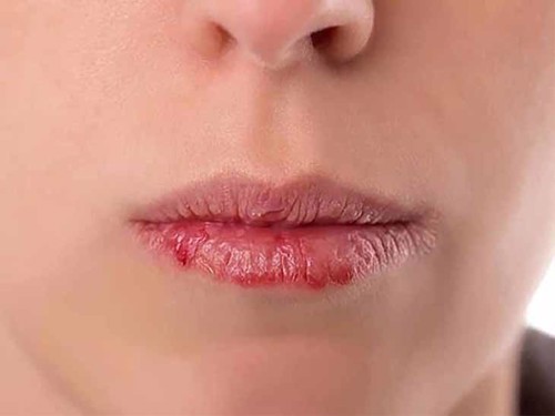 Bị chàm môi sau xăm môi phải làm sao? 